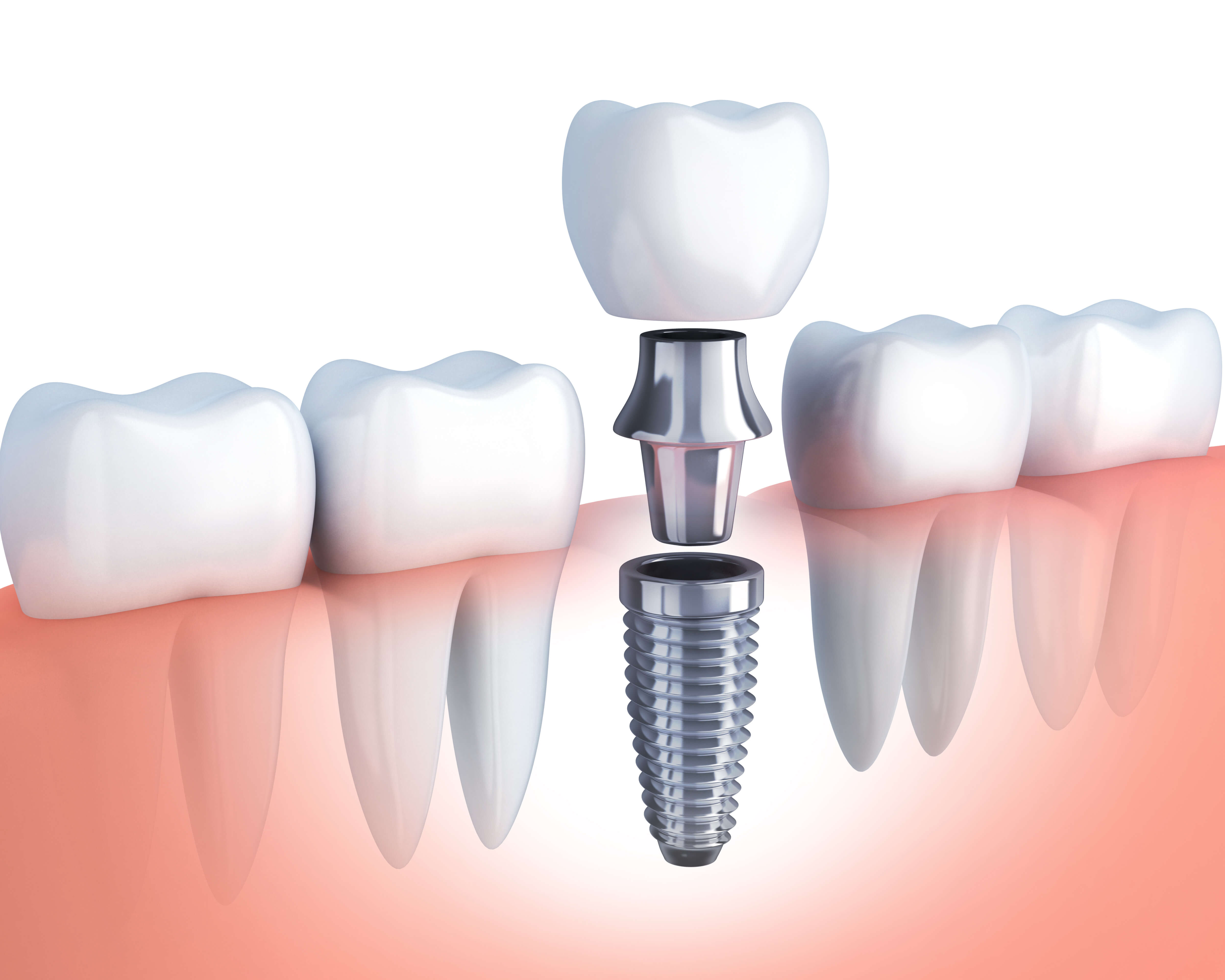 Couronne sur implant Centre dentaire StBasile